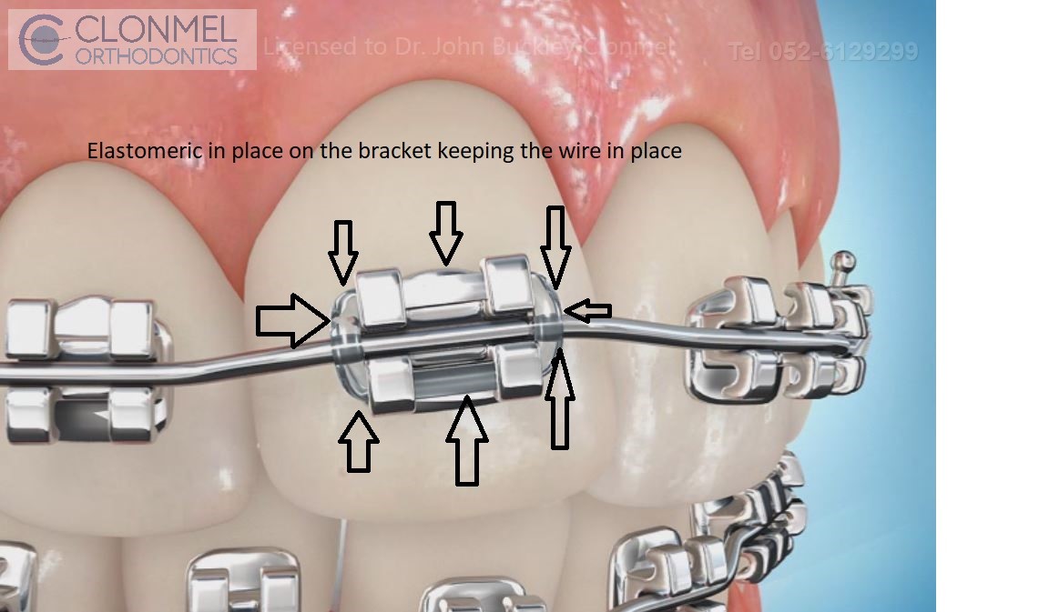 Elastomeric-in-place How are braces  put/placed on the teeth?
