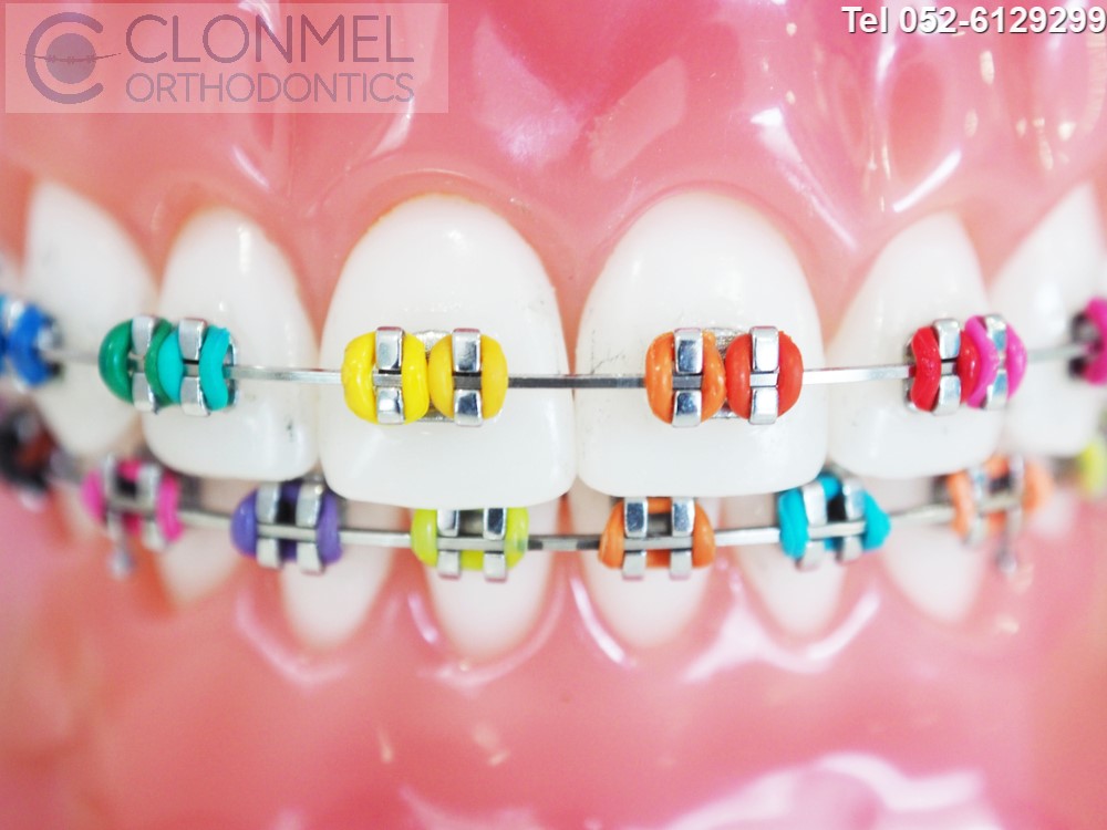 Multi-colours-pw What are Coloured Braces?