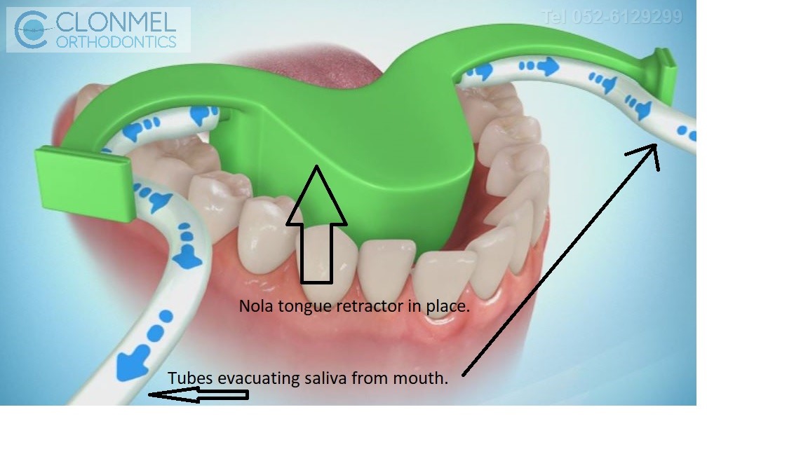 Nola-retractor-1a How are braces  put/placed on the teeth?