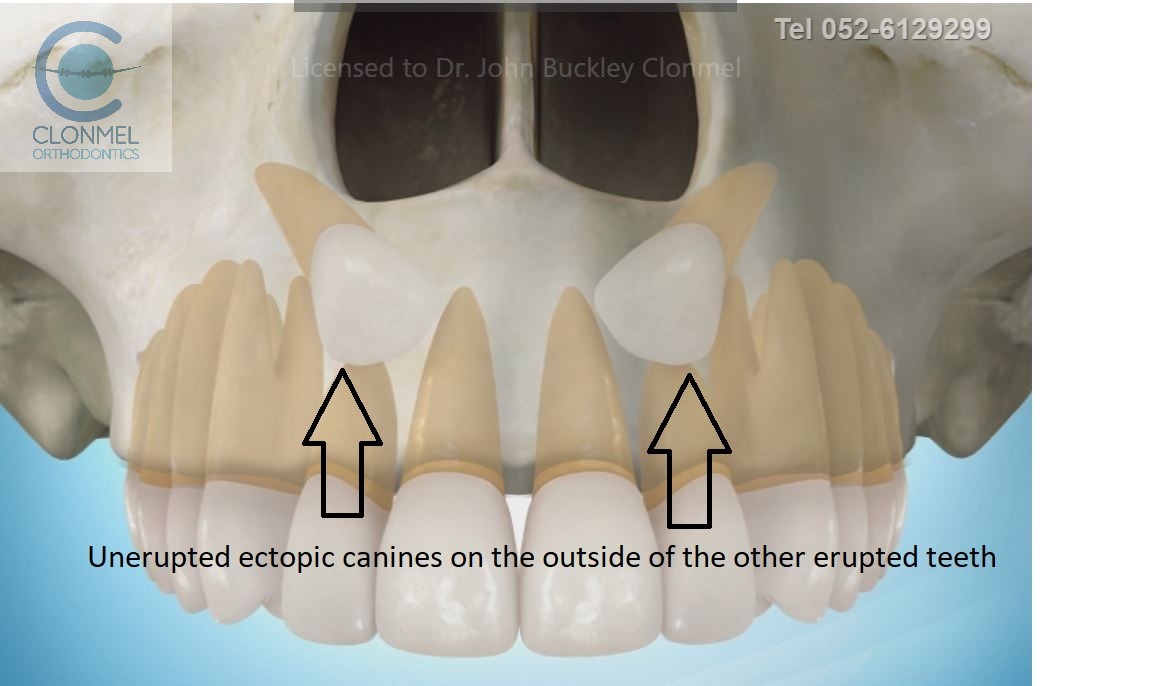 canines-2-post-paint-pw Ectopic Canines
