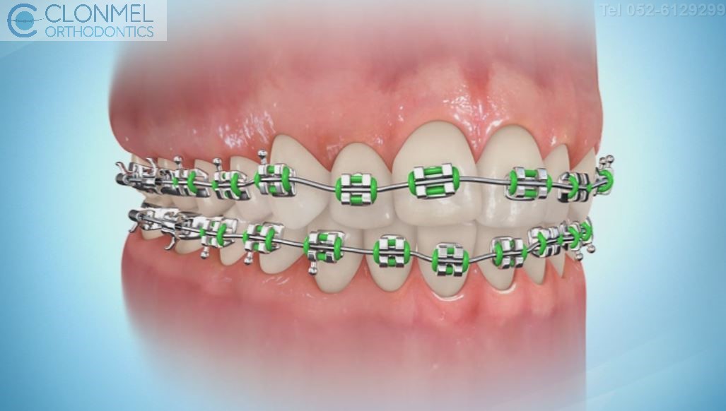 coloued-braces-8pw What are Coloured Braces?