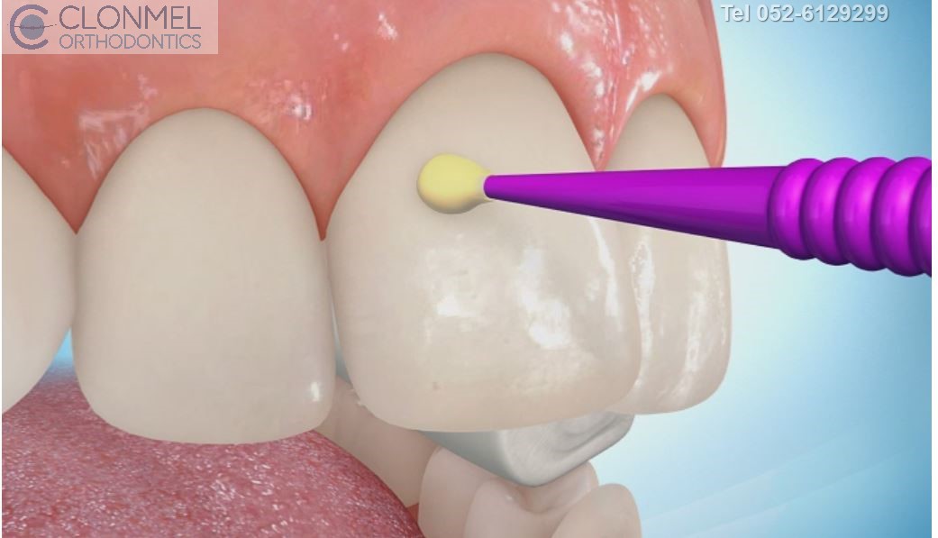 etch-2-prew How are braces  put/placed on the teeth?