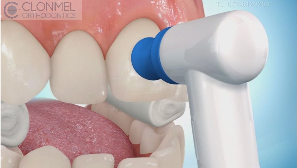 polishing-defin-1 How are braces  put/placed on the teeth?