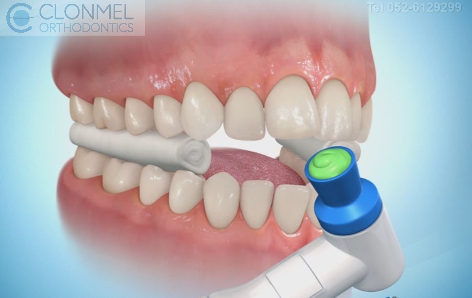 polishing-defin-2 How are braces  put/placed on the teeth?