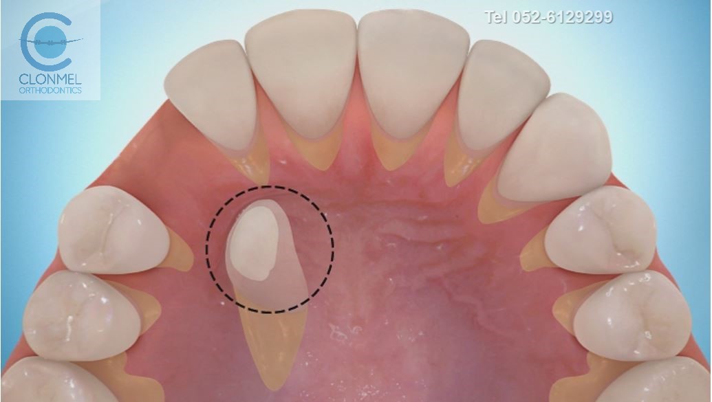 Canine-exposed-002-pw Ectopic Canines