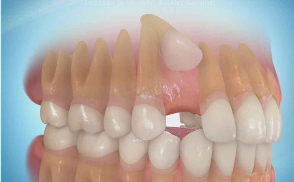 labial-canine-2-002 Ectopic Canines