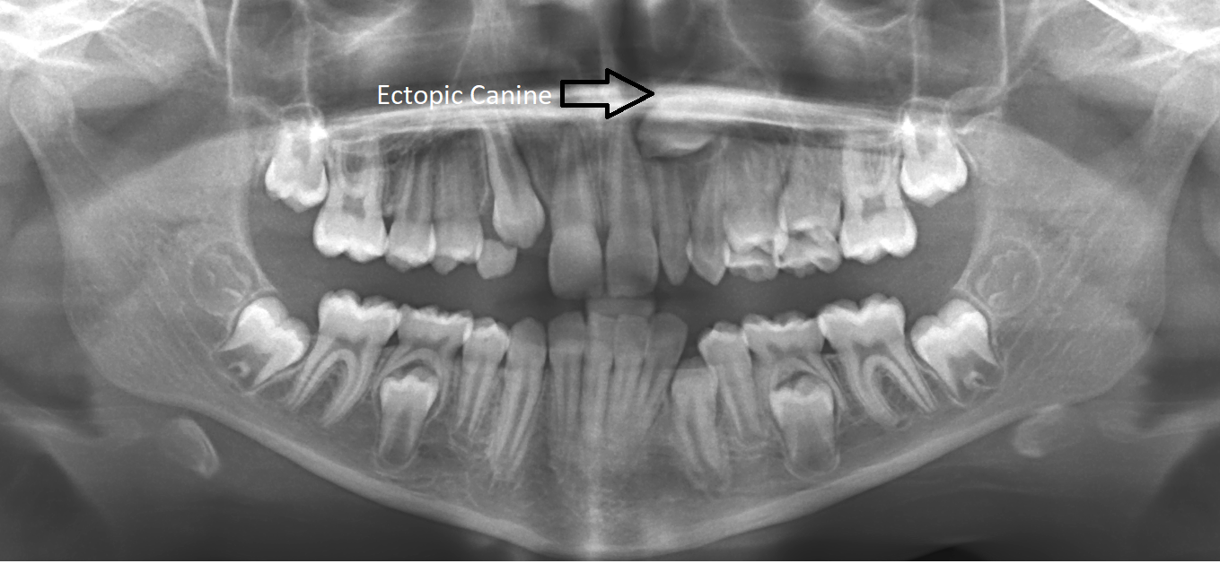 opg-2 Ectopic Canines
