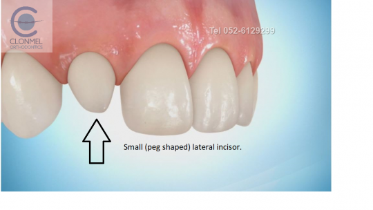 peg-shaped-lateral-e1620073292282 Ectopic Canines