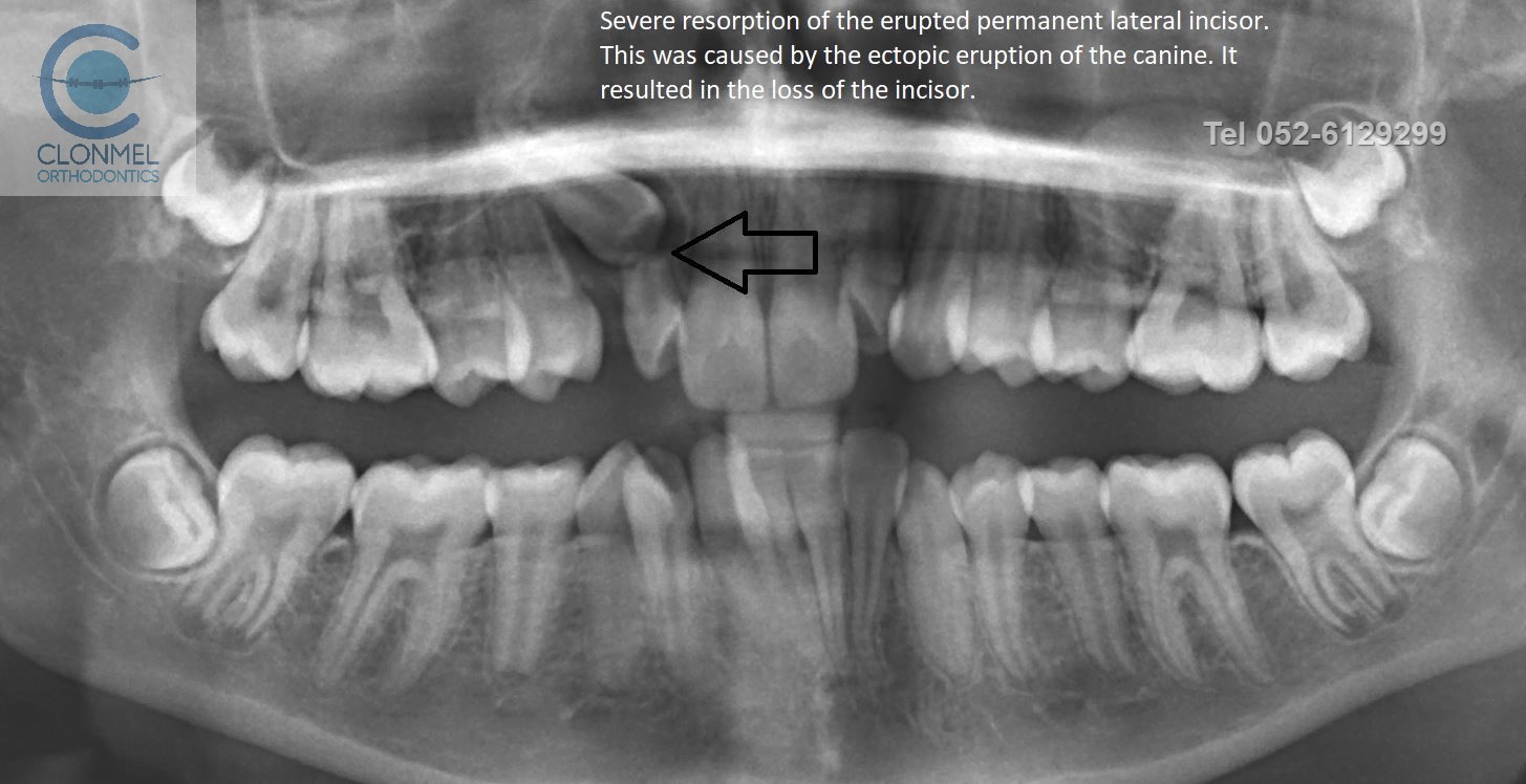 severe-resorption Ectopic Canines