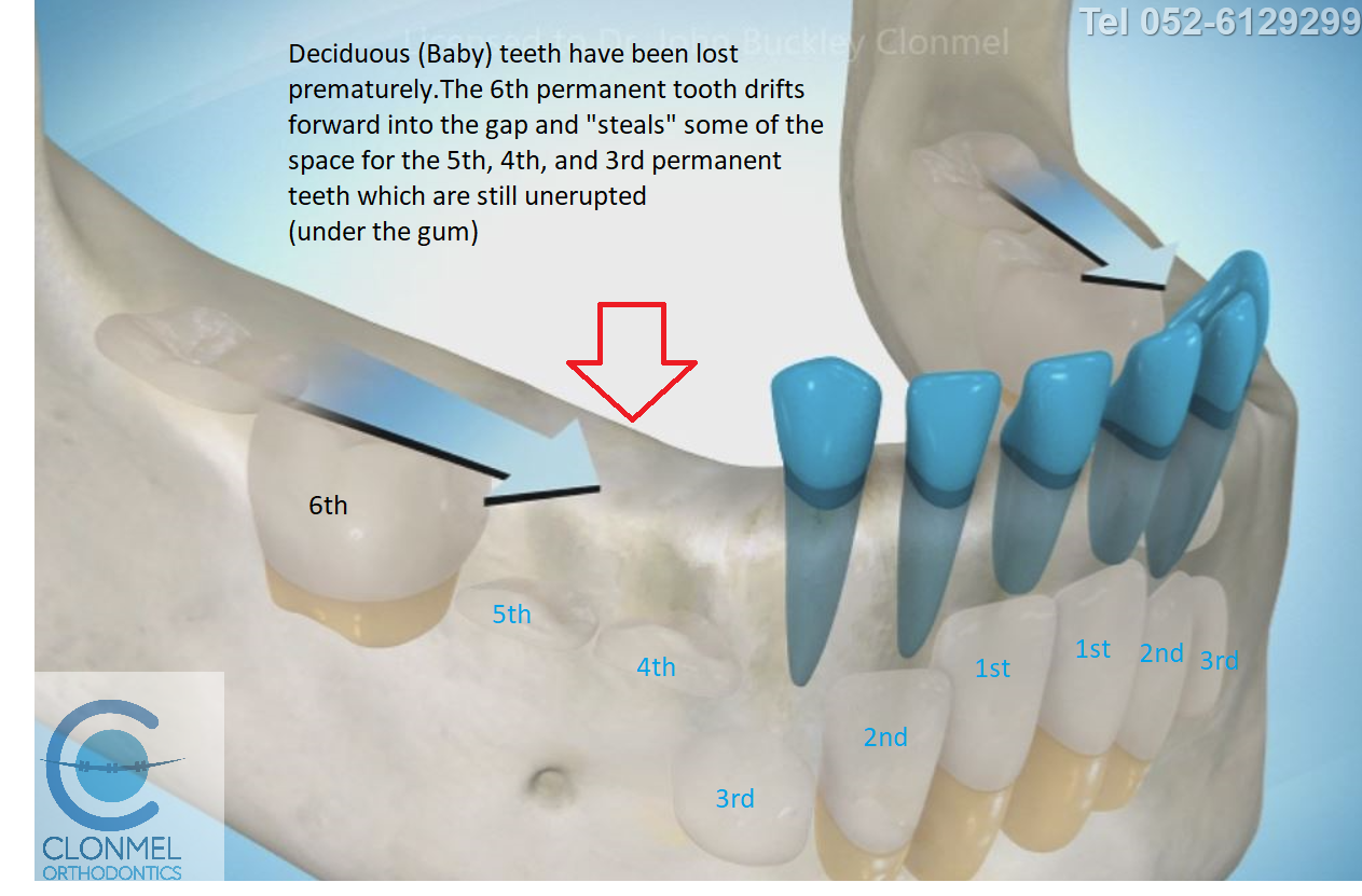 Cr2-post-art What is dental (orthodontic) crowding?