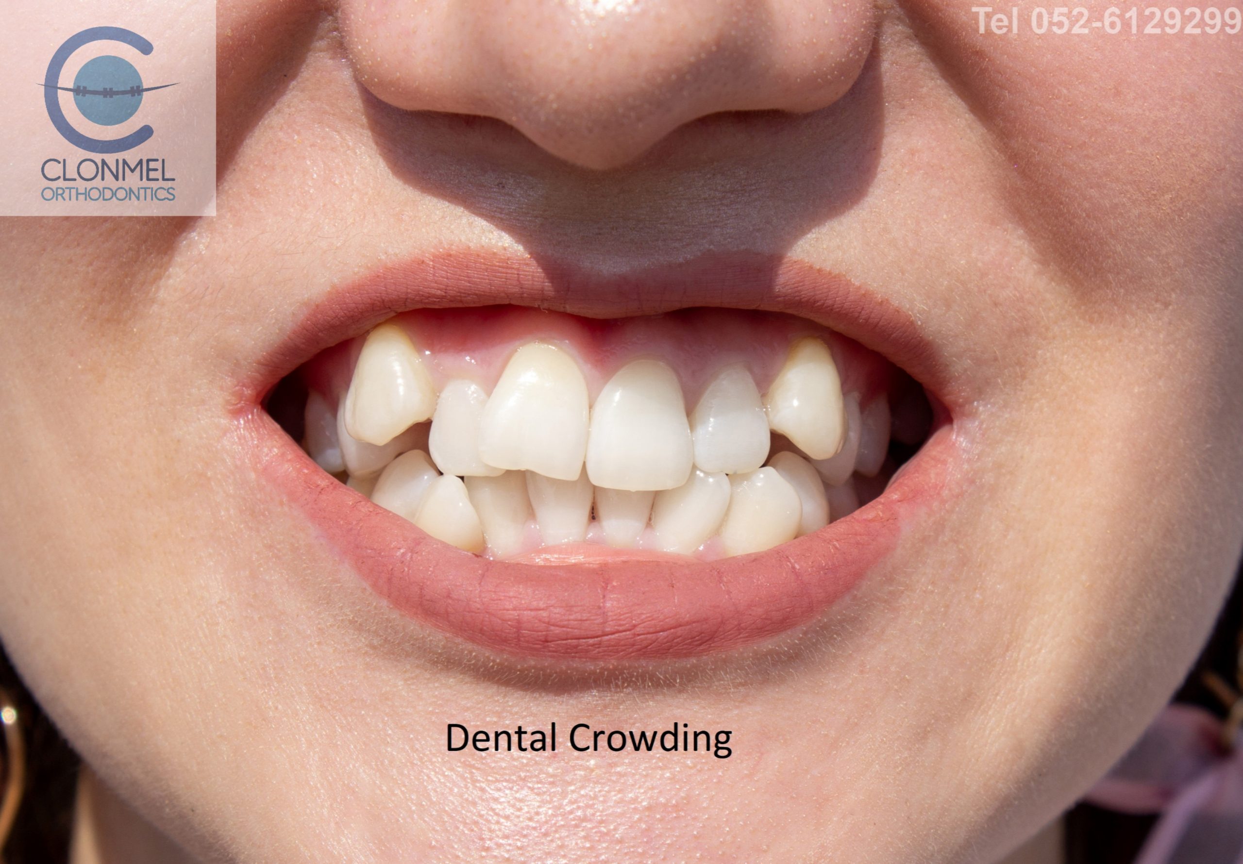 Dental-Crowding-1-scaled What is dental (orthodontic) crowding?