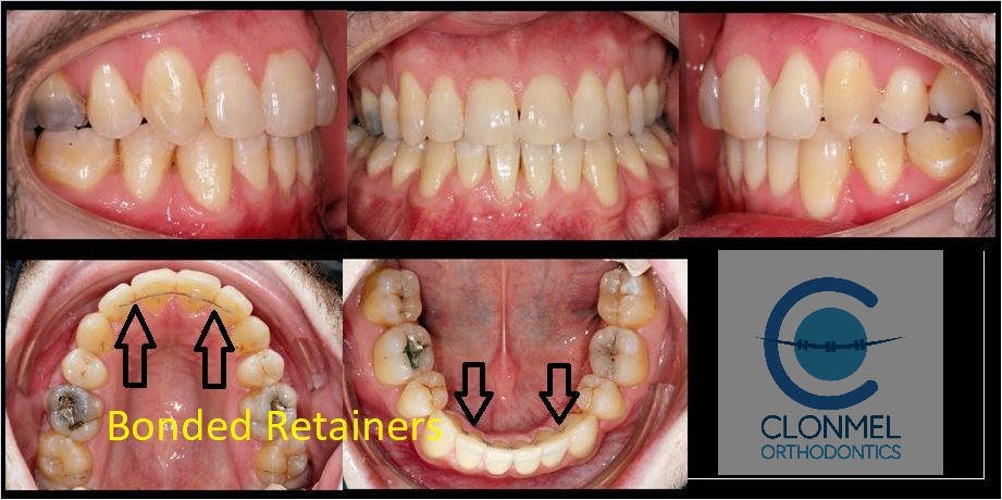 Johnny-bonded-retainer What are bonded  (fixed) orthodontic retainers?