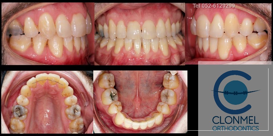 Johnny-post-rex What is dental (orthodontic) crowding?