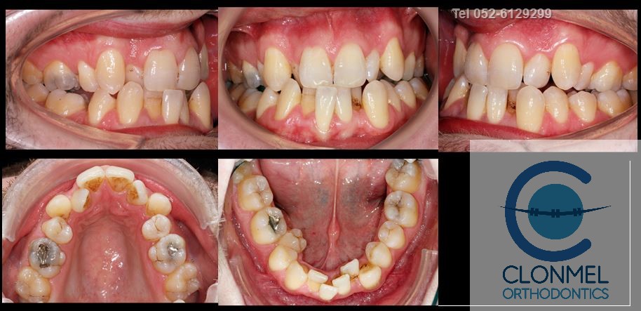 Johnny-pre-rex What is dental (orthodontic) crowding?