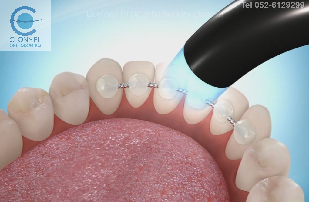 bonded-retainer-pre-export-5-1 What are bonded  (fixed) orthodontic retainers?