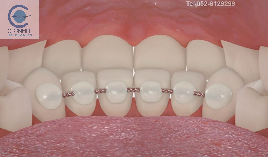 bonded-retainer-pre-export-6 What are bonded  (fixed) orthodontic retainers?