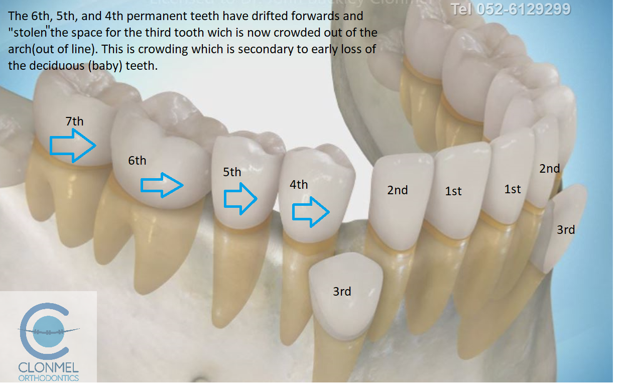 cr4-post-art What is dental (orthodontic) crowding?