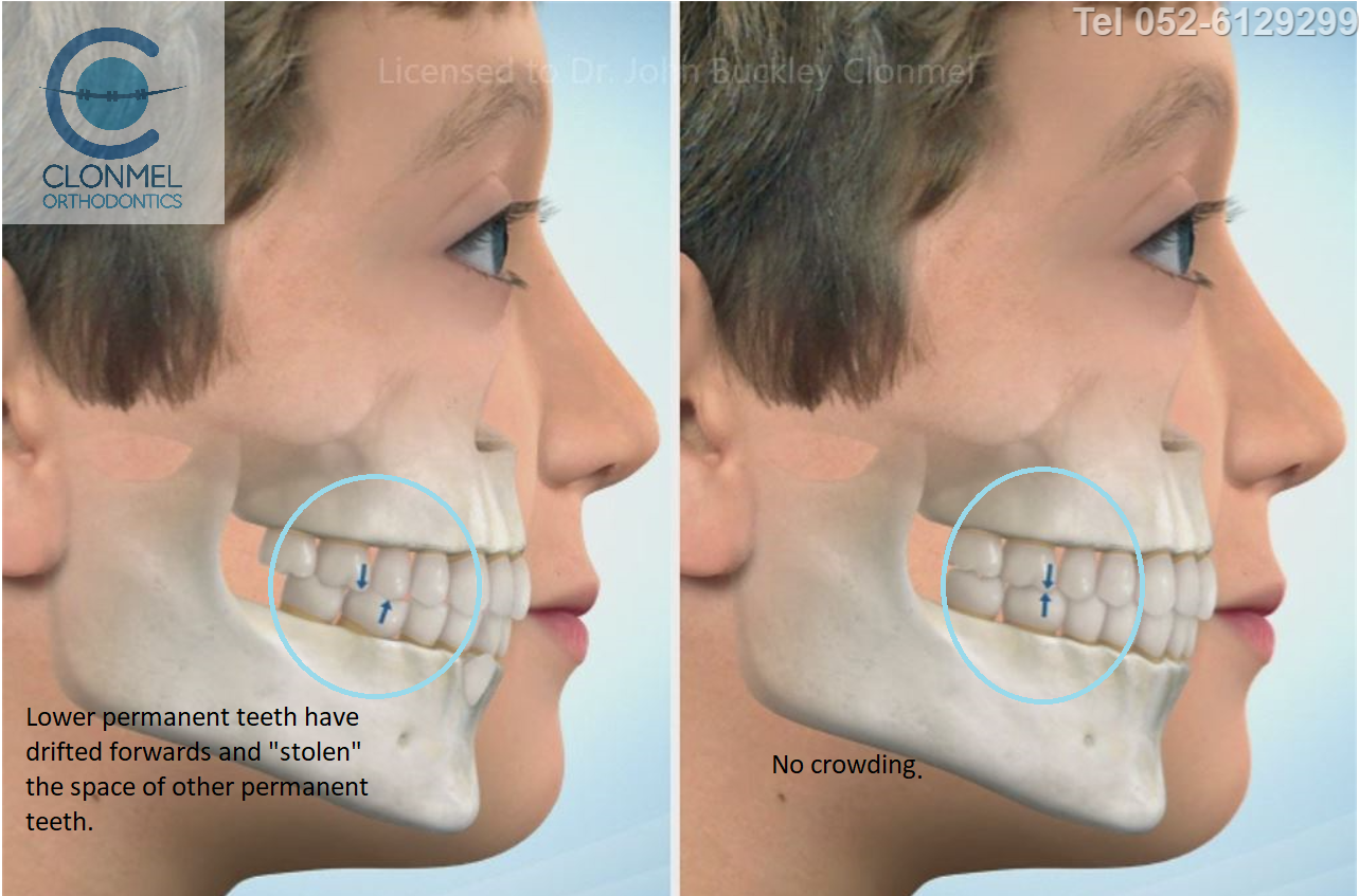 cr5-post-art What is dental (orthodontic) crowding?