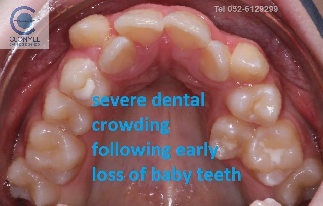cr6-post-art What is dental (orthodontic) crowding?