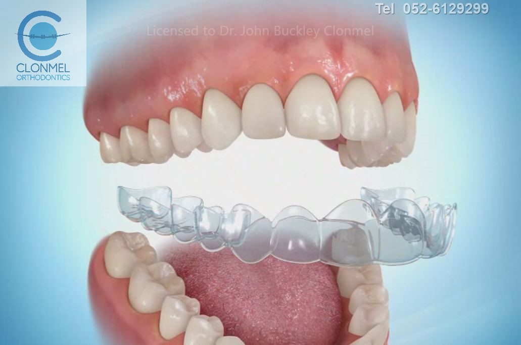 Bonded Retainer Retention After Orthodontics Clear Aligners