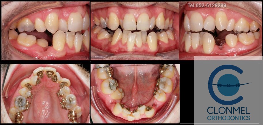 johnny-mid-rx What is dental (orthodontic) crowding?