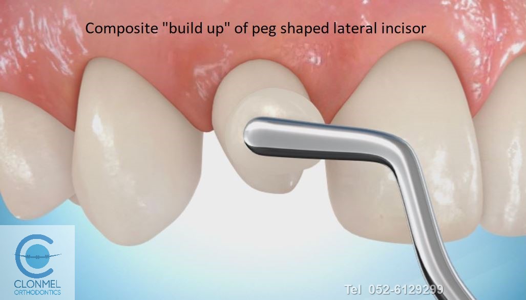 peg-3-post-art What are peg shaped lateral incisors?