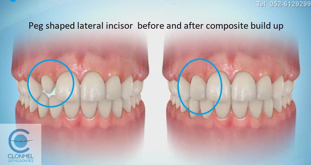 peg-41-post-art-JPG What are peg shaped lateral incisors?