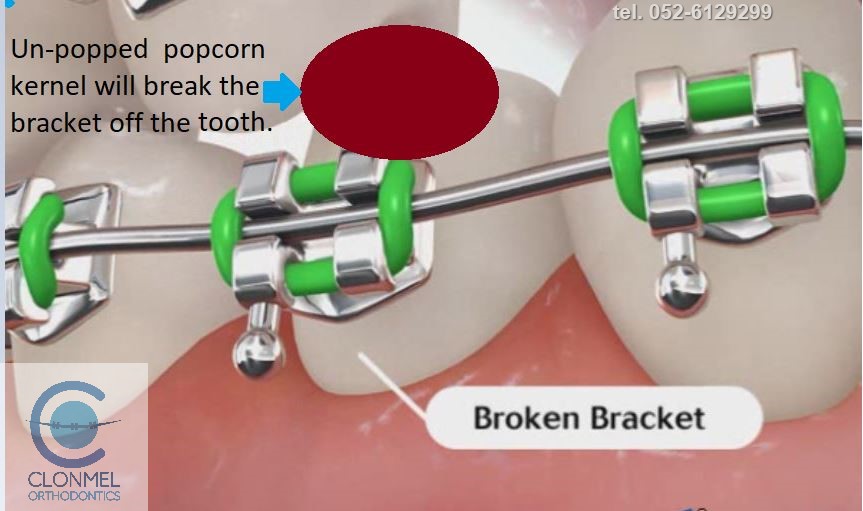 popcorn-10-JPG Popcorn and orthodontic treatment.