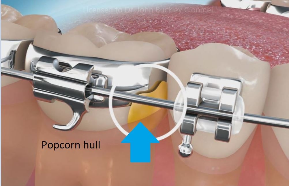 popcorn-12 Popcorn and orthodontic treatment.