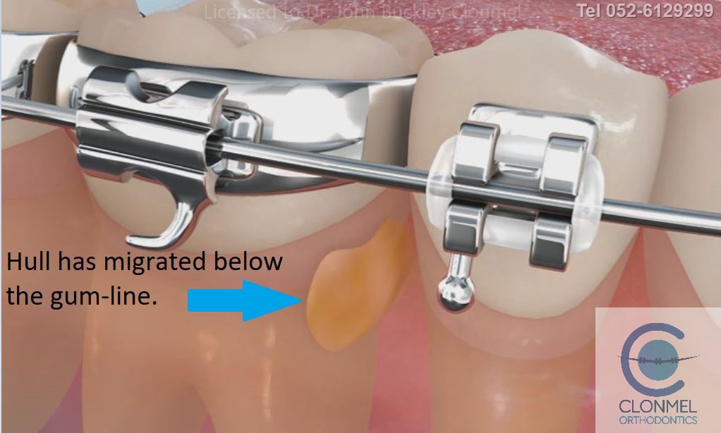 popcorn-15 Popcorn and orthodontic treatment.