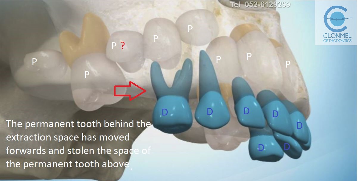 PIC-2-POST-U-MARK Why do we try to avoid losing baby teeth prematurely?