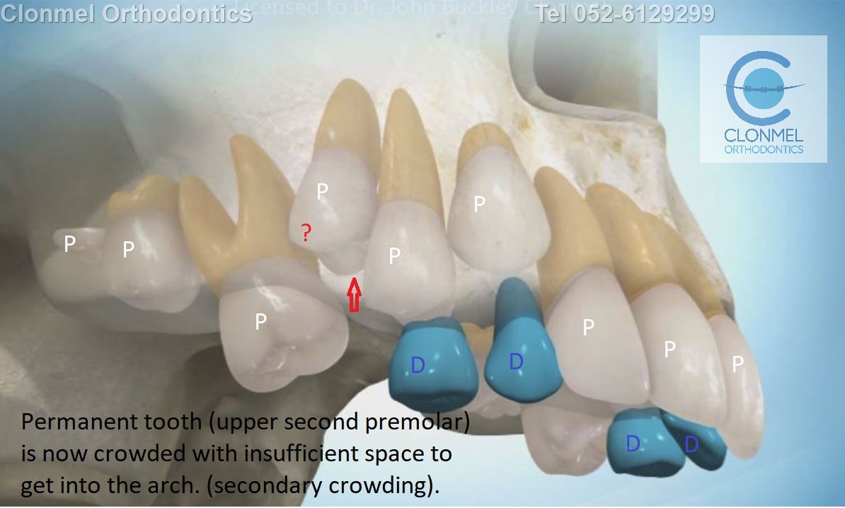 pic-3-post-u-mark Why do we try to avoid losing baby teeth prematurely?