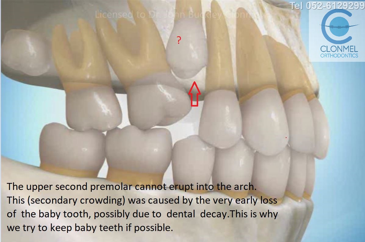 pic-4-post-u-mark Why do we try to avoid losing baby teeth prematurely?