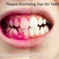 Plaque disclosing tablets in Orthodontic treatment.