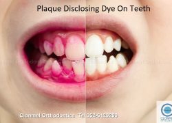 Plaque disclosing tablets in Orthodontic treatment.