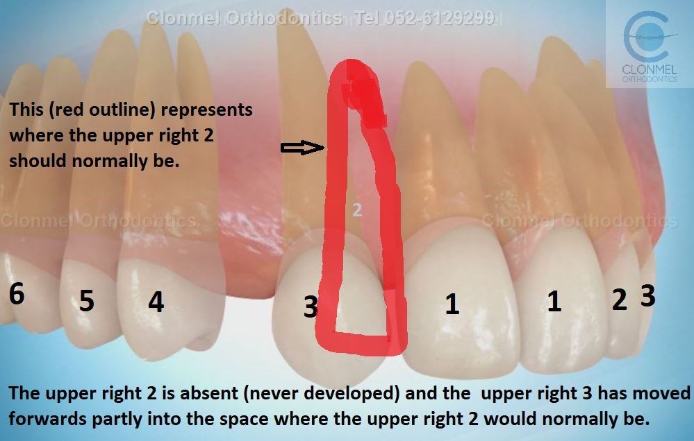 pic-2-post-watermark Missing Lateral Incisors  Part 1.