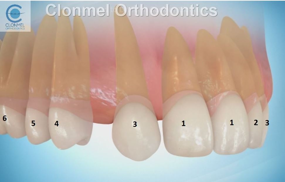 pic-9 Missing Lateral Incisors  Part 1.