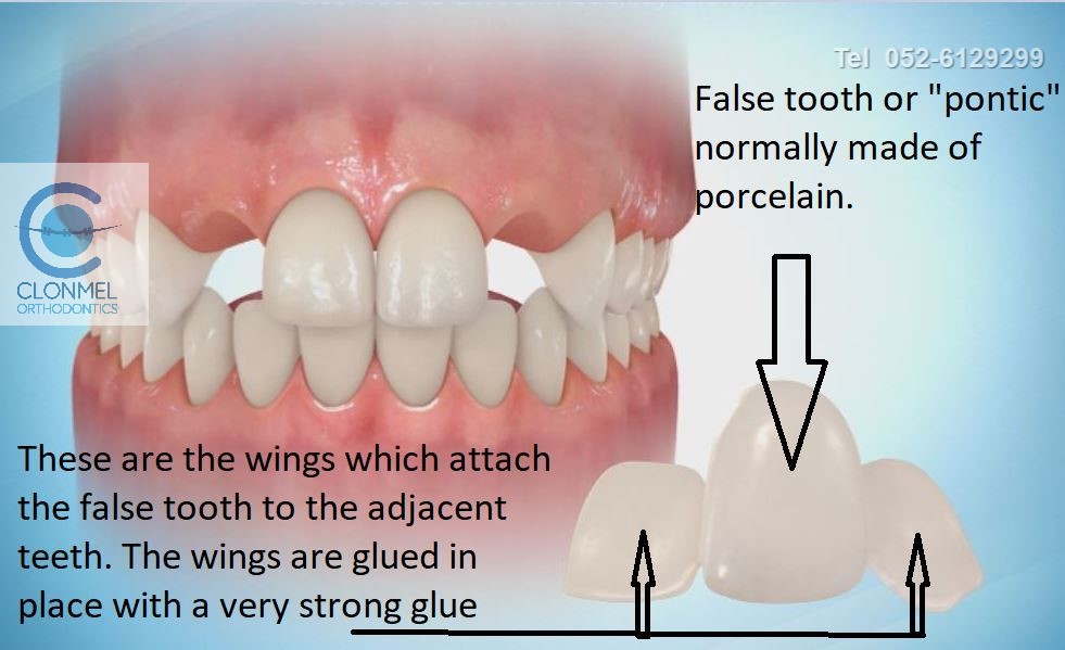 Bridge-1-post-art-pre-w-mark. Missing Lateral Incisors  Part 2. "The re-opening the space option."