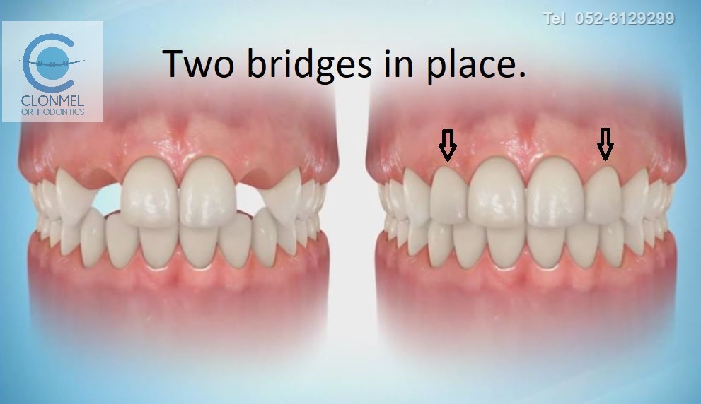 bridge-4-post-art-work-pre-w-mark Missing Lateral Incisors  Part 2. "The re-opening the space option."