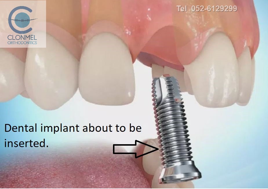 implant-1-post-art-pre-w-mark Missing Lateral Incisors  Part 2. "The re-opening the space option."