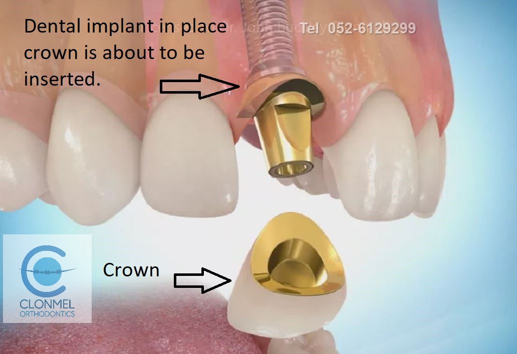 implant-3-post-art-pre-w-mark Missing Lateral Incisors  Part 2. "The re-opening the space option."