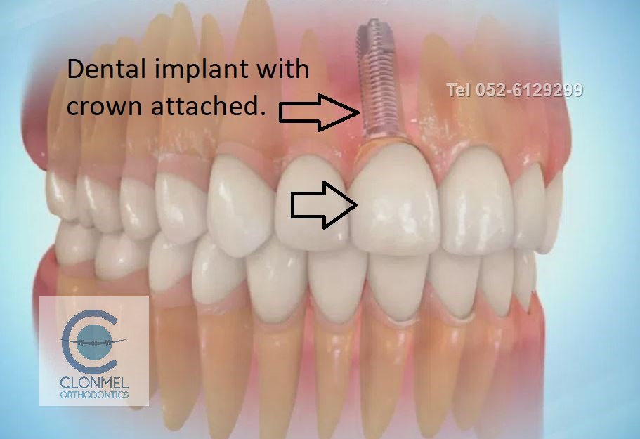 implant-4.JPG-post-art-work Missing Lateral Incisors  Part 2. "The re-opening the space option."