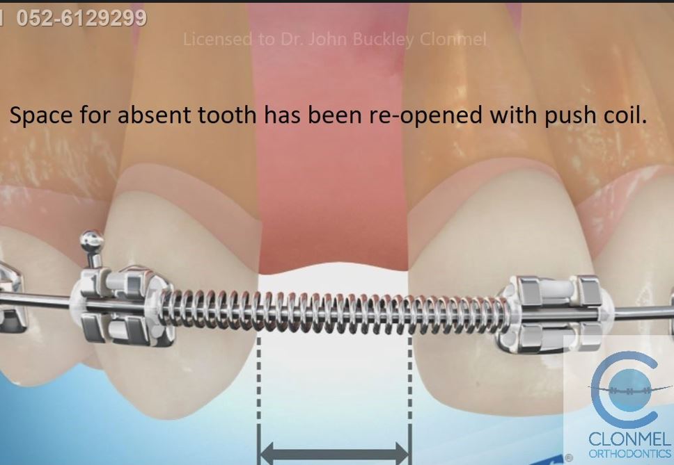 push-coil-post-art-post-w-mark-2 Missing Lateral Incisors  Part 2. "The re-opening the space option."