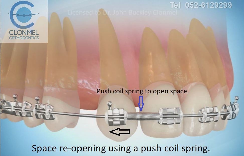 reopen-push-coil-post-w-mark Missing Lateral Incisors  Part 2. "The re-opening the space option."