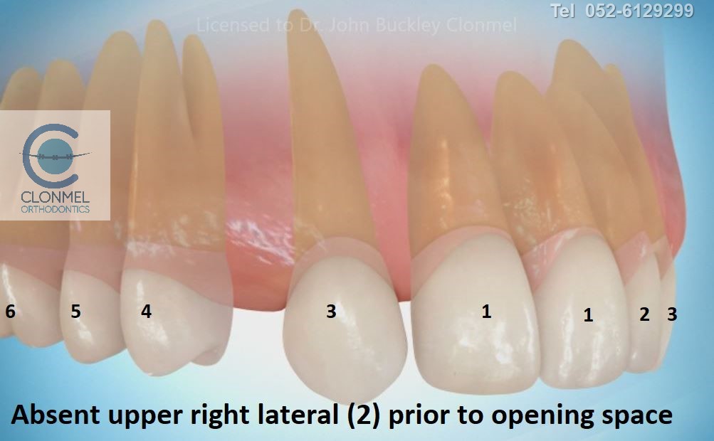 reopening-space-post-art-pre-watermark-1 Missing Lateral Incisors  Part 2. "The re-opening the space option."