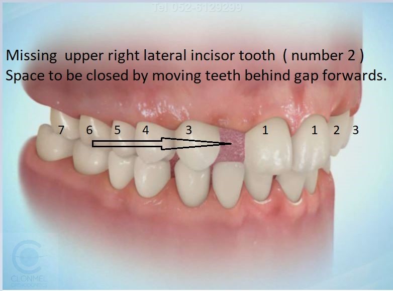 space-close-1-post-art Missing Lateral Incisors  Part 3. The "closing the space" option, with canine substitution.