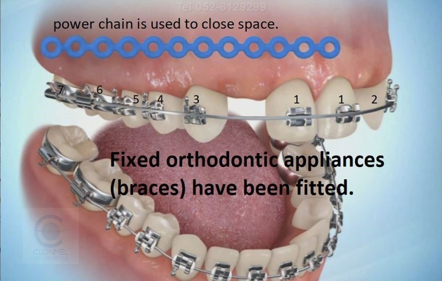 space-close-2-again-post-art Missing Lateral Incisors  Part 3. The "closing the space" option, with canine substitution.