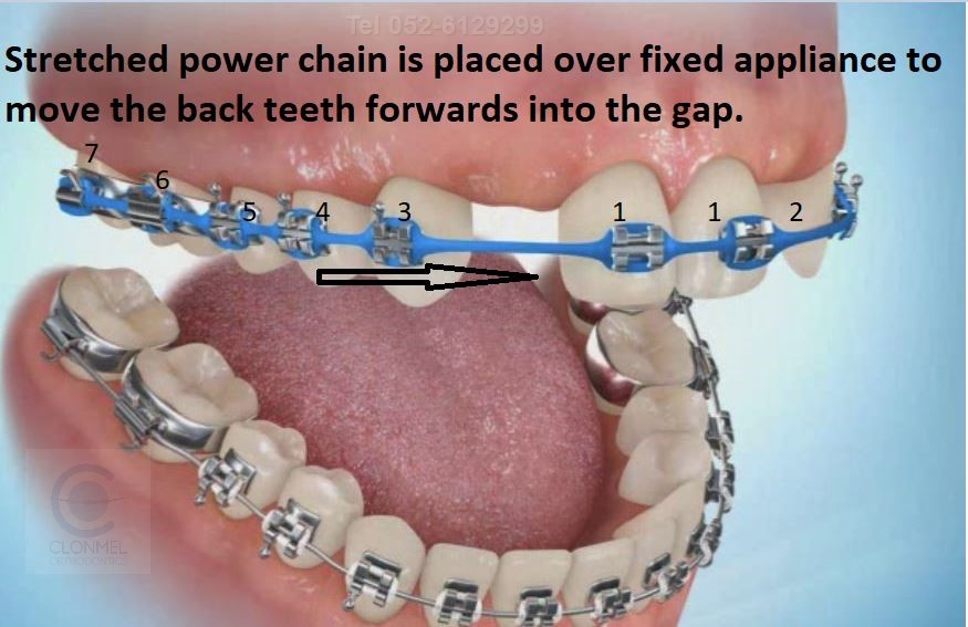 space-close-3post-art Missing Lateral Incisors  Part 3. The "closing the space" option, with canine substitution.