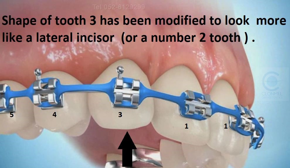 space-close-6post-art Missing Lateral Incisors  Part 3. The "closing the space" option, with canine substitution.