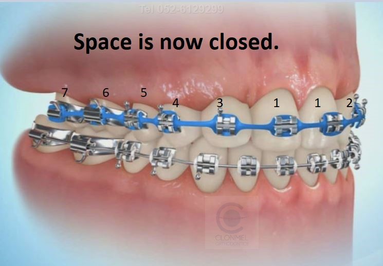 space-close-7post-art Missing Lateral Incisors  Part 3. The "closing the space" option, with canine substitution.